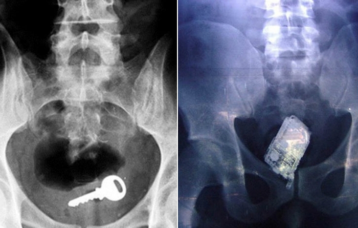10 рентгеновских снимков со странными предметами, застрявшими в прямой кишке.