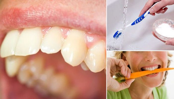 Удаление зубного камня в домашних условиях.