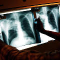 Исследователи поняли, почему «российский туберкулез» один из самых страшных